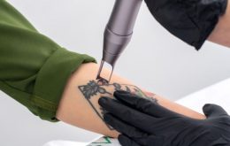 Tattoo Laserentfernung in Nürnberg